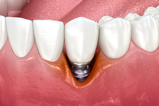 Weichgewebschirurgie bei Implantaten