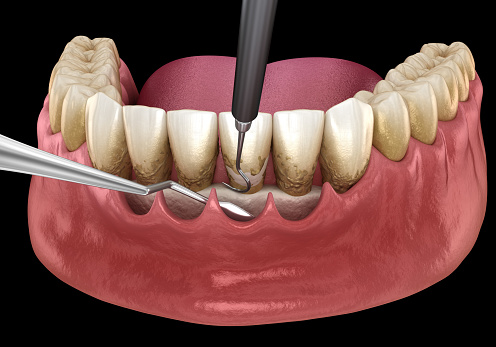 Regenerative Parodontalchirurgie