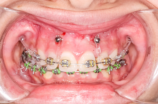 Einbringen von kieferorthopädischen Mini-Implantaten (TADs)