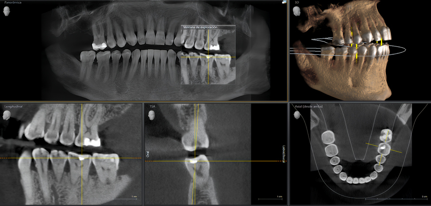 Diagnostik mit großvolumigem DVT (3D-Röntgen)